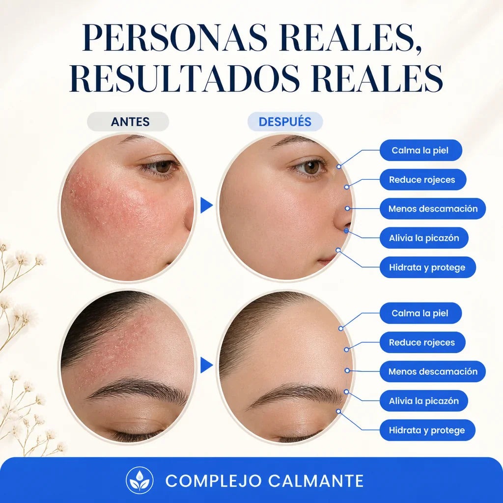 RoyceDerm Seborrheic Dermatitis
