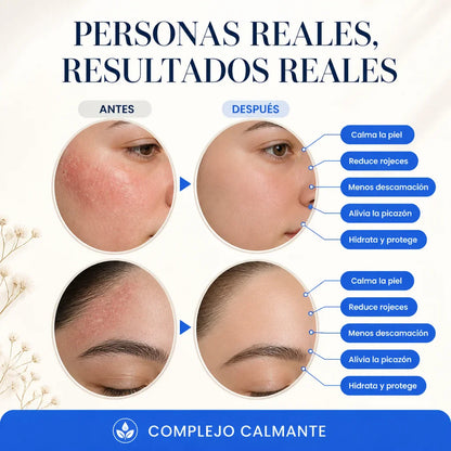 RoyceDerm Seborrheic Dermatitis